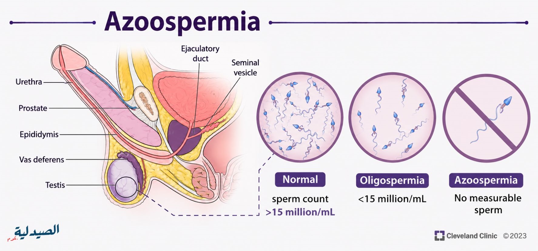 Asthenozoospermia - حركة الحيوانات المنوية Sperm Motility